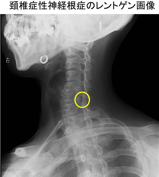 頚椎症性神経根症のレントゲン画像