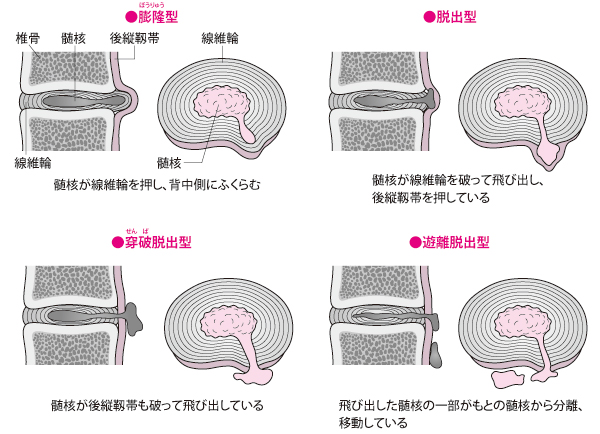 ヘルニア画像