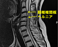 頚椎ヘルニアｍＲＩ