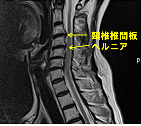 頚椎ヘルニアｍＲＩ