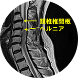 ぎっくり腰