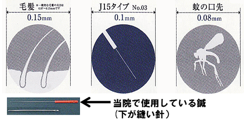 鍼の比較画像