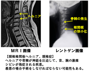 頚椎ヘルニア画像