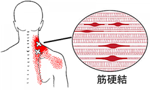 筋硬結