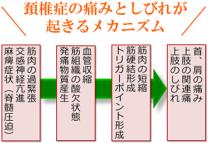 頚椎症が起きるメカニズム