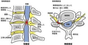 頚椎ヘルニア画像