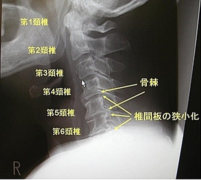 頚椎症レントゲン写真