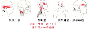 後頭神経痛トリガーポイント