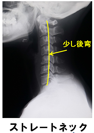 ストレートネック