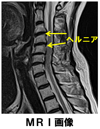 頚椎ヘルニア