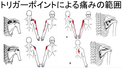 トリガーポイント鍼治療