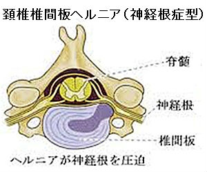 頚椎ヘルニア神経根型