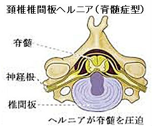 頚椎ヘルニア脊髄症型