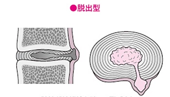 頚椎ヘルニア脱出型