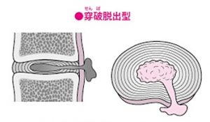 頚椎ヘルニア穿破脱出型