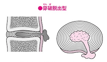 頚椎ヘルニア穿破脱出型