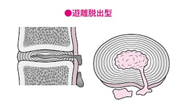 頚椎ヘルニア遊離脱出型