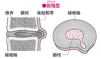 頚椎ヘルニア膨隆型