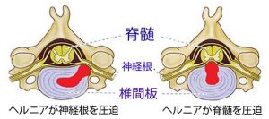 頚椎ヘルニア画像