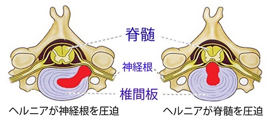 頚椎ヘルニア画像