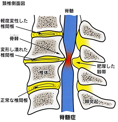 頚椎症