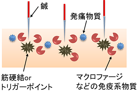 鍼の免疫強化