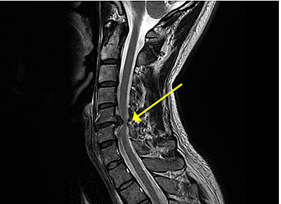 頚椎症性脊髄症