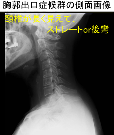 胸郭出口症候群側面像